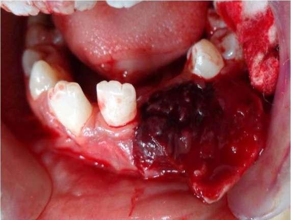 Intra oral examination revealed a swelling of a size approximating 3X2 cm on both buccal and lingual aspect, extending from lower left lateral incisor to the left second premolar causing obliteration