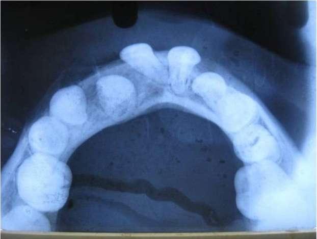 Figure 6: A postoperative intraoral photograph Figure. 10. A postoperative view of OPG at 6 months. DISCUSSION Figure 7: A postoperative mandibular occlusal radiograph at 3 months.