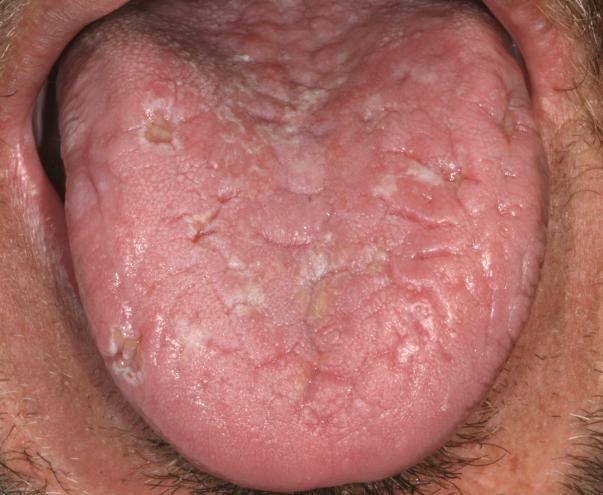 A white lesion on the right lateral tongue was also noted. No diagnosis or definitive treatment was rendered at that time.