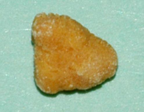 stones as: 1. Calcium oxalate 70-80% 2.