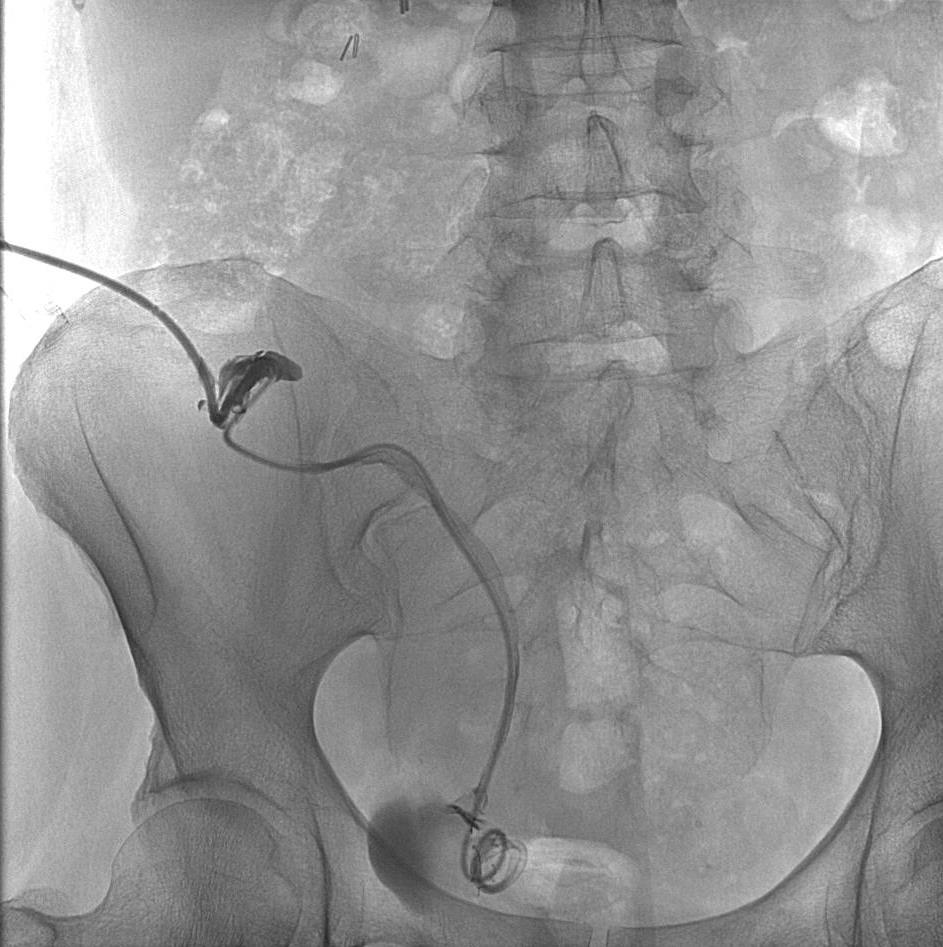 Clinical Follow Up: Renal-Cutaneous Fistula 3 months post ablation, the patient developed a renal-cutaneous fistula with urine draining from the ablation probe site Under fluoroscopic
