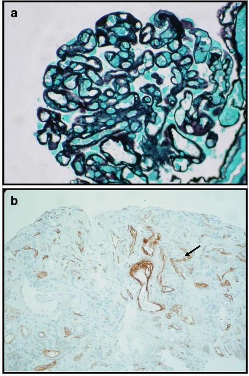 Renal allograft biopsy (silver staining) Evidence of double contours in capillary loops Mesangial proliferation and matrix expansion and basement membrane