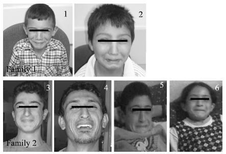 Individuals with Urofacial (Ochoa) Syndrome Who are