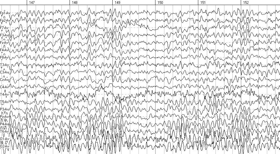 4. Eyes Closed background EEG rhythms. 14 Fragments. Two fragments of EEG recorded in Eyes Closed (EC) condition in a reference-free montage - common average are presented below.