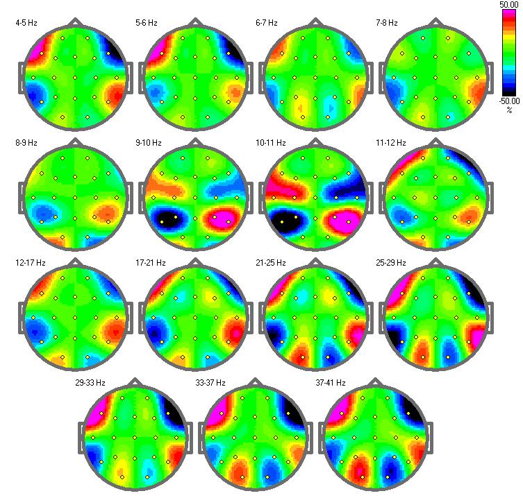 20 Asymmetry maps of power spectra in eyes closed conditions for 2 Hz bands. Note that an asymmetry higher than 50% may be a sign of abnormality 10.