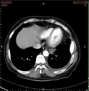 Reduction of pleural effusion and