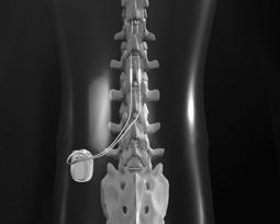 pain or FBSS ASA 2 May offer some temporary relief for pts with radicular low back pain 1. Chou R, et al. Spine 2009;34(10):1078-93. 2. Rosenquist RW, et al.