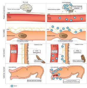 Pathophysiology 3 Main Mechanisms: Slowed GI motility Decreased secretion of fluids in the gut Increased sphincter tone Nonpharmacological Prevention and Treatment 1 st Line Recommendations: Standard