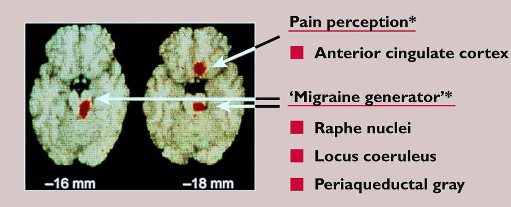Pathophysiology of migraine; Dysfunction of brainstem
