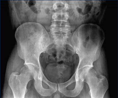 Case of an HLA-B27 Positive Patient and a Radiographic Abnormality The patient is a