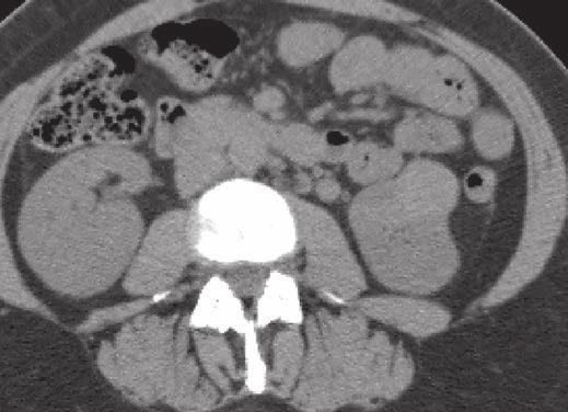 CT of Small Renal Masses A B Fig. 2 42-year-old woman with angiomyolipoma without visible fat (2.7 2.6 cm) in left kidney.