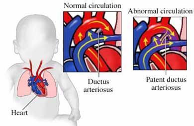 3 PATENT DUCTUS ARTERIOSUS (PDA) Normal circulation in fetal life PDA in utero allows arterial blood to bypass the unexpanded lungs In fetal life, i. pulmonary vascular resistance is high ii.