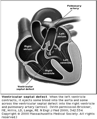 the left atrium is shunted to the right atrium then into the right ventricle and back to the lungs Rarely get CHF Systolic ejection murmur The increased volume and work