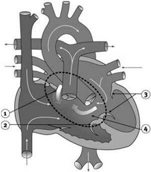 ASD Atrioventricular Canal Floppy tricuspid valve Floppy mitral valve VSD Abnormal development of the endocardial cushion Common in Down syndrome Complete AV Canal Partial AV canal 1 valve Mitral