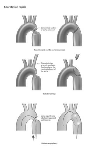 Treat the heart failure (digoxin & Lasix ) Prostin Surgical Intervention Anastomosis