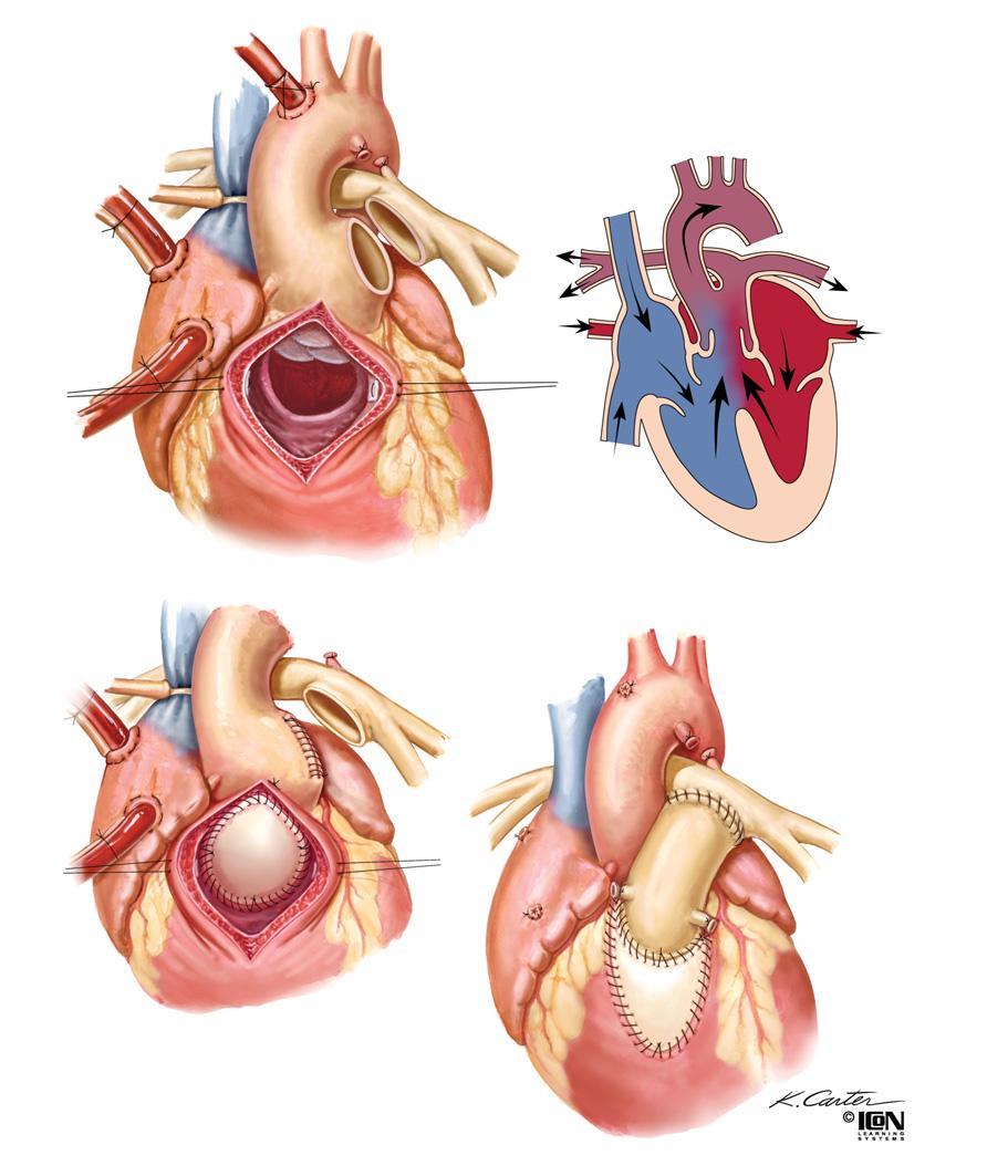 SURGICAL INTERVENTIONS FOR Figure 46-6 Truncus Arteriosus Ligated ductus arteriosus Bisected pulmonary trunk Common aortopulmonary trunk with single large valve Oxygenated Deoxygenated Right