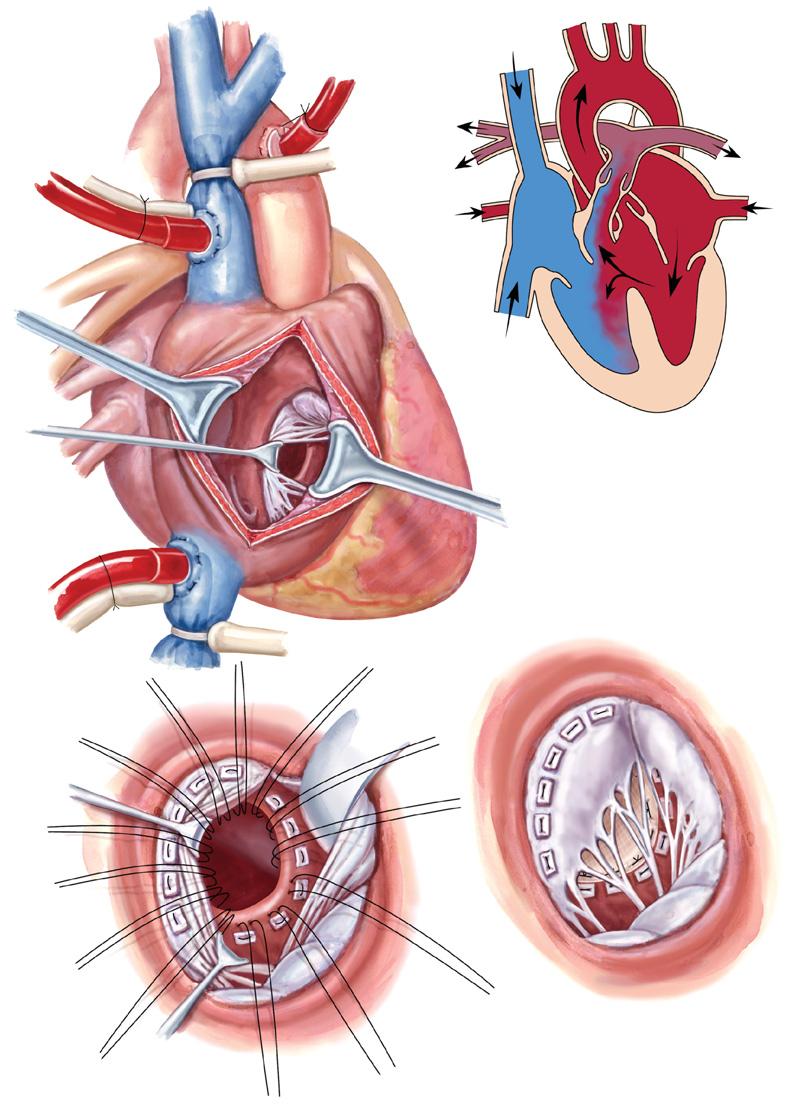 SURGICAL INTERVENTIONS FOR Figure 46-1 Transatrial Repair of Ventricular Septal Defect (VSD) Deoxygenated Cannula in superior Aorta Pulmonary trunk Oxygenated Retracted septal leaflet Right ventricle