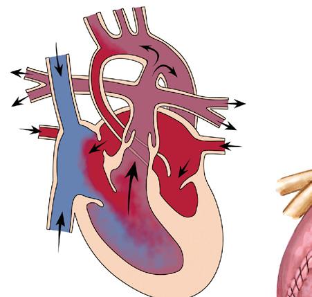 SURGICAL INTERVENTIONS FOR Figure 46-2 Norwood Correction of HLHS Atretic aorta Patent ductus