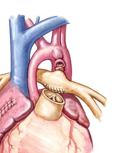 distal pulmonary Right atriotomy Modified Blalock- Taussig shunt Superior Innominate of neoaorta