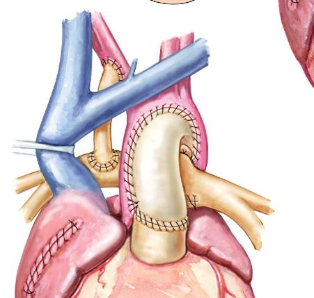 interatrial septum. The main pulmonary is transected and a neoaorta is created.