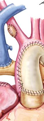 Neoaorta Atretic aorta Main pulmonary The main pulmonary and a cryopreserved aortic homograft