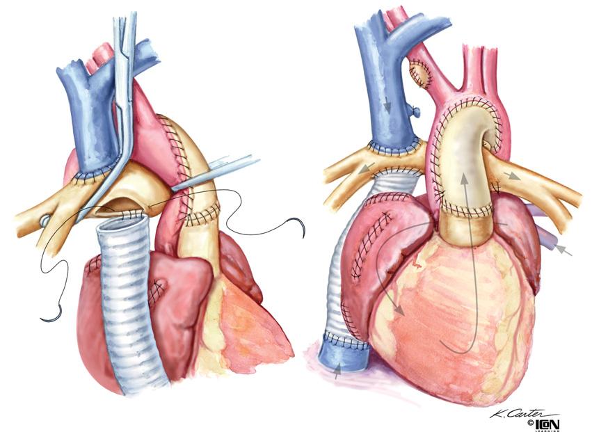 SURGICAL INTERVENTIONS FOR Figure 46-3 Superior Norwood Correction of HLHS: Fontan Circulation Stage III A modified Fontan procedure is completed 6 12 months after stage II utilizing an extracardiac