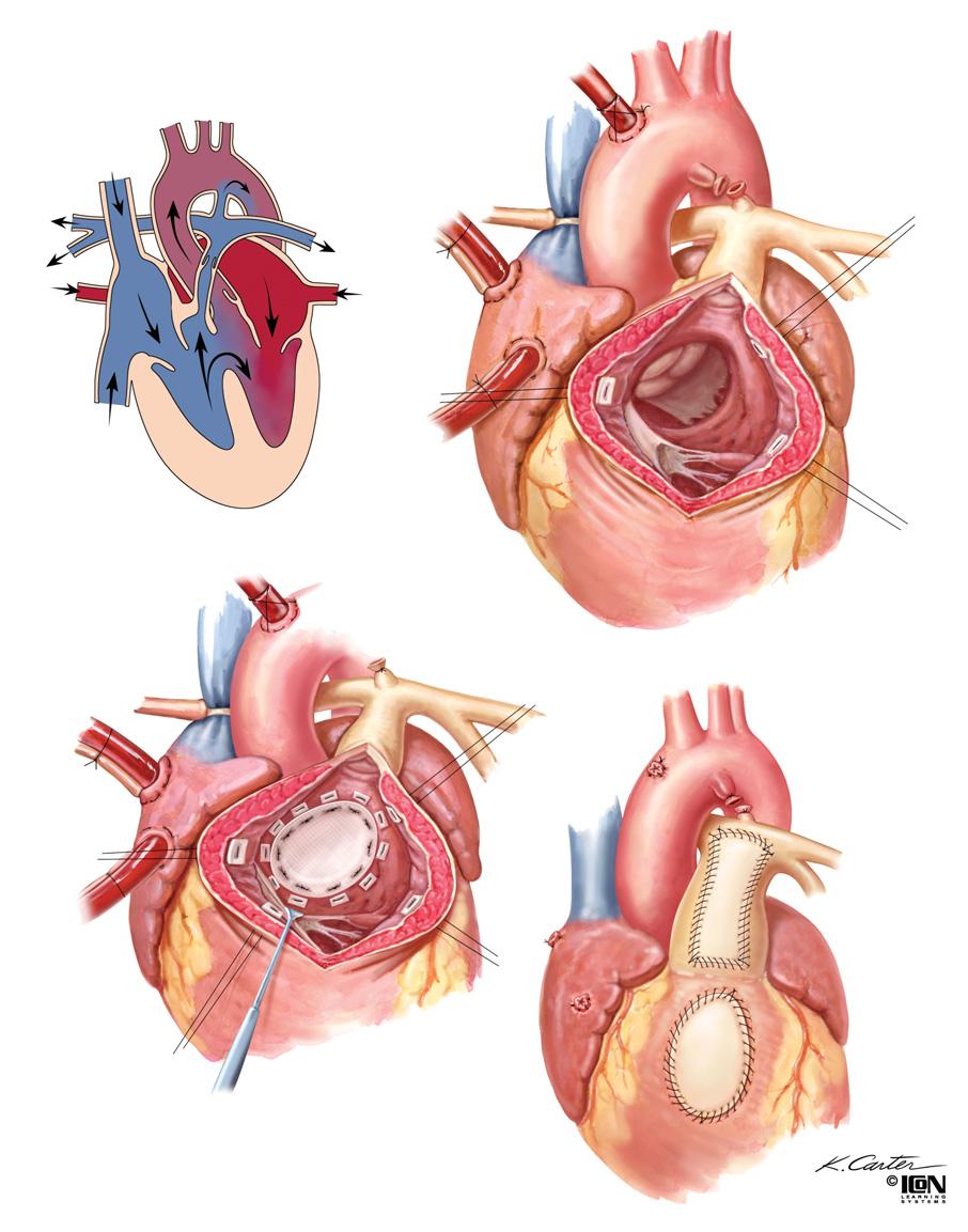 SURGICAL INTERVENTIONS FOR Figure 46-4 Tetralogy of Fallot Deoxygenated Patent ductus arteriosus Stenotic pulmonary Ligated ductus arteriosus Stenotic pulmonary trunk Oxygenated VSD with right to