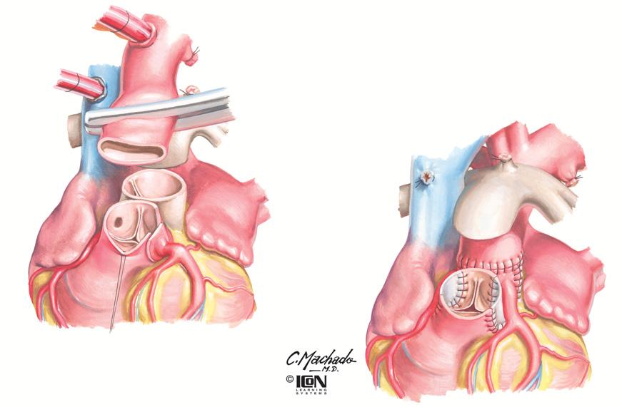 SURGICAL INTERVENTIONS FOR Figure 46-5 Initial steps Aorta divided Arterial Repair of Transposition of the Great Arteries Ligamentum arteriosum divided LCA with button resected from the aorta