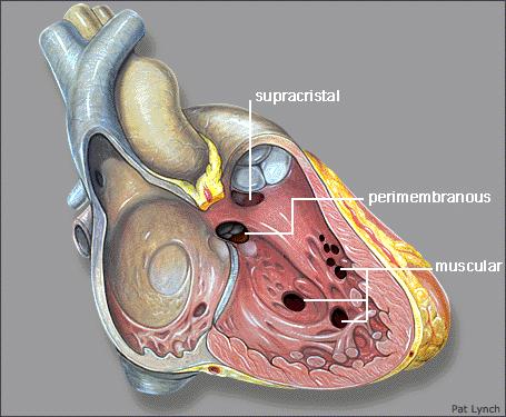 Ключові терміни: 11 These defects represent abnormal communications between the high pressure left side of the heart and the low pressure right side of the heart.
