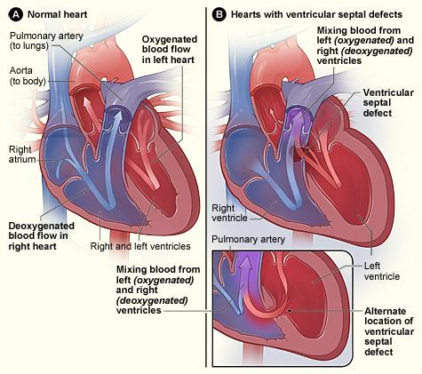 The consequences of this shunting of blood are: turbulence of abnormal blood flow producing a heart murmur in systole and sometimes in diastole; excessive blood flow into the lungs causing shortness