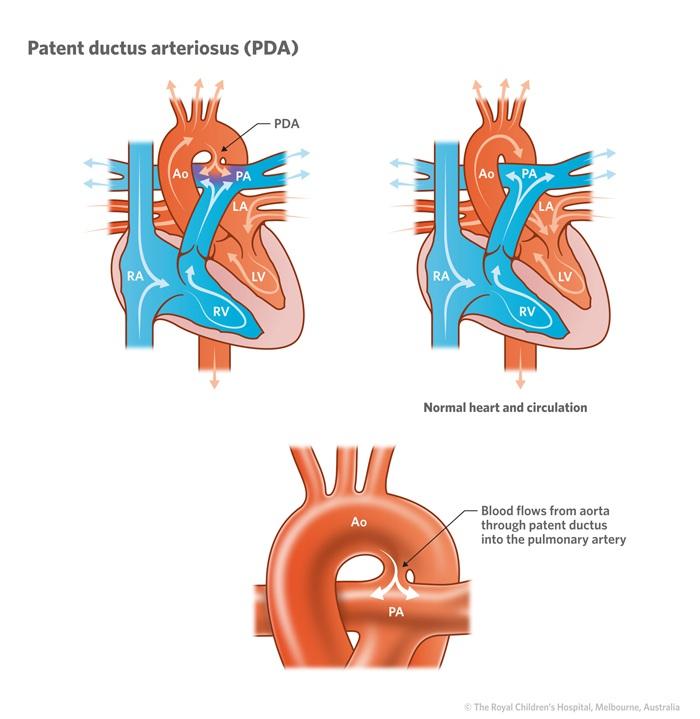 patent ductus arteriosus (PDA) Untreated defects with large shunts will eventually result in injury to the pulmonary arterioles, vascular obstruction, and pulmonary hypertension.