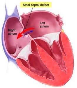 Secundum ASDs may be single or multiple (fenestrated atrial septum), and openings 2 cm in diameter are common in symptomatic older children.