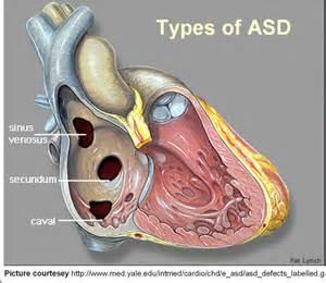 Atrioventricular Septal Defects (Ostium Primum and Atrioventricular Canal or Endocardial Cushion Defects) 20 CLINICAL MANIFESTATIONS.