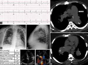 Even an extremely large secundum ASD rarely produces clinically evident heart failure in childhood.