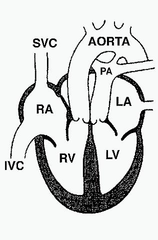 in order for this system to work, there must be a connection between the system and pulmonic circulations. Sometimes this is through a ventricular septal defect or an atrial septal defect.