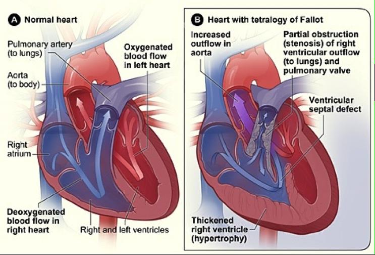 Tetralogy of Fallot constitutes 4%-9% of congenital heart disease and is the most common cyanotic congenital heart disease when considering all age groups together.