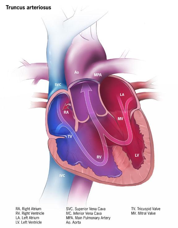 Cyanotic Congenital Heart Disease 28 Total anomalous pulmonary venous return (TAPVR) occurs in about 1%-2% of patients with congential heart disease.