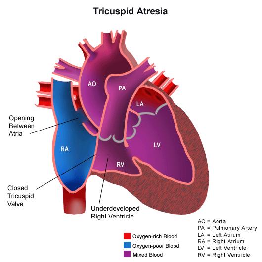 They may have associated lesions such as TGA, VSD, PDA, right aortic arch, pulmonic stenosis or atresia. Communication between right and left circulation is essential to sustain life.