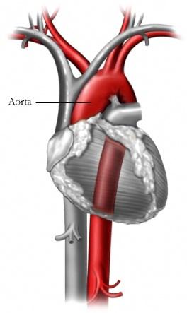 Ключові терміни: 4 Acyanotic Congenital Heart Disease Heart and Main Vessels Atrioventricular Septal Defects (Ostium Primum and Atrioventricular Canal or Endocardial Cushion Defects) Cyanotic