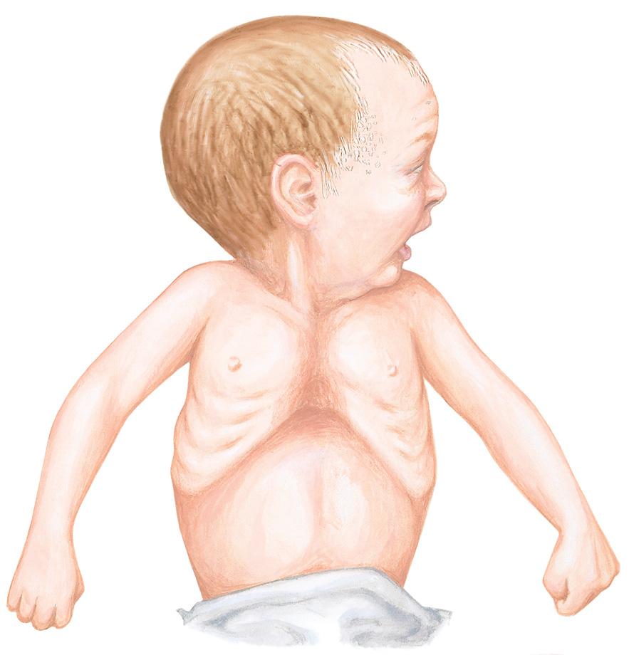 Figure 43-6 Clinical Characteristics of Too Much Pulmonary Flow (Pulmonary Volume Overload) Perspiration and tense, anxious facies Infant with respiratory distress (including orthopnea and tachypnea)