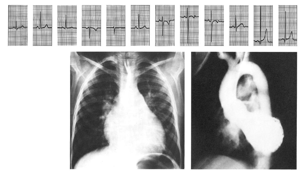 AN APPROACH TO CHILDREN WITH SUSPECTED CHD Figure 43-7 Anomalies of the Ventricular Septum Ventricular septal defect ECG 1 2 3 avr avl avf V1 V2 V3 V4 V5 V6 PT AO VSD RV X-ray: Ventricular septal