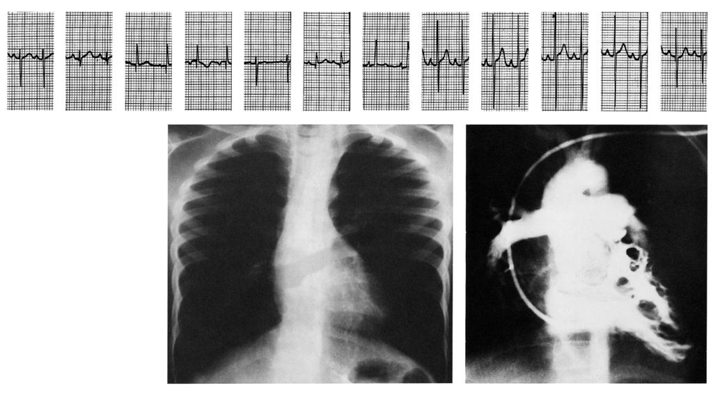 ventricular angiocardiogram: AO, aorta; PT, pulmonary trunk; LV, left ventricle; RV, right ventricle; VSD, ventricular septal defect Anomalies of the Right Ventricular Outflow Tract 1 2 3 avr avl avf