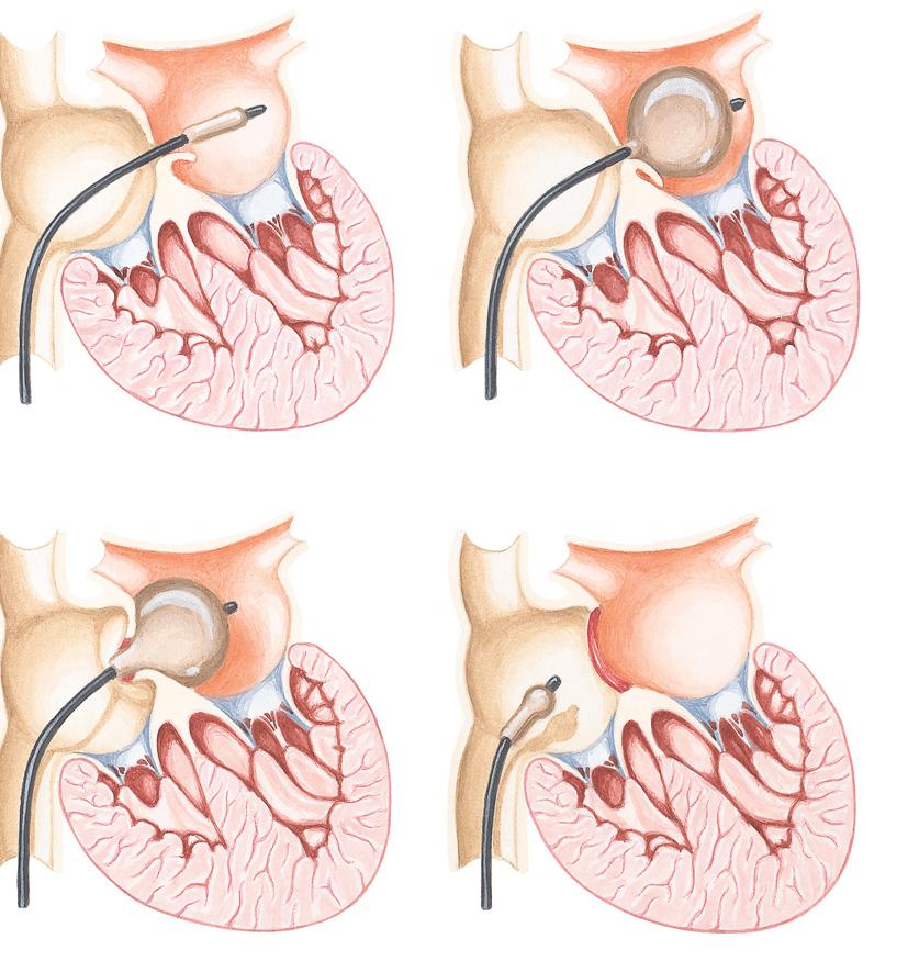 Figure 43-2 Transposition of Great Arteries Balloon Atrial Septostomy (Technique) 1. Balloon-tipped catheter introduced into left atrium through patent foramen ovale 2. Balloon inflated 3.