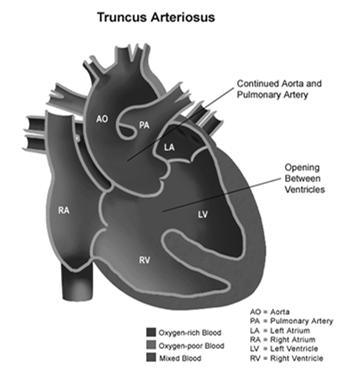 Truncus Arteriosus Only a single arterial trunk leaves the heart