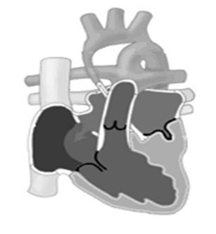 Keep sats 75 to 85% Avoid excessive pulmonary vasodilation PBF CHF Surgical Management: Norwood: rebuild the tiny ascending aorta Stage II: Glenn Operation State III: Fontan procedure Cardiac
