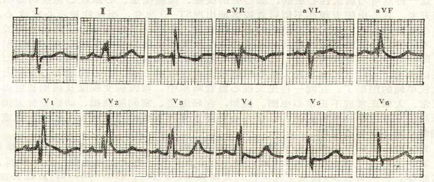 ECG Right axis deviation Enlargement of the RA and RV Minor right ventricular conduction delay