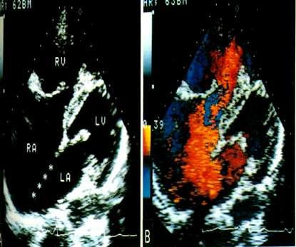 Echocardiography Enlargement of the RA and