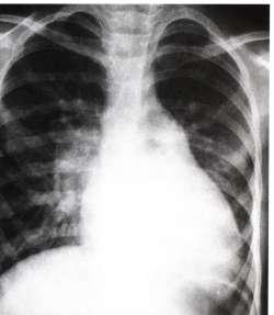 Large VSD Chest X-ray: Gross cardiomegaly with prominence of LV, RV, LA and PA Pulmonary vascular markings increase and