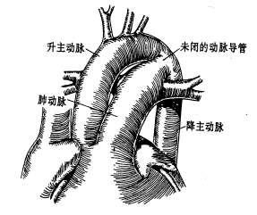 During fetal life, most of the pulmonary arterial blood is shunted through the ductus arteriosus into the aorta.