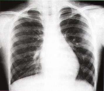 Chest X-ray Prominent pulmonary artery with increased